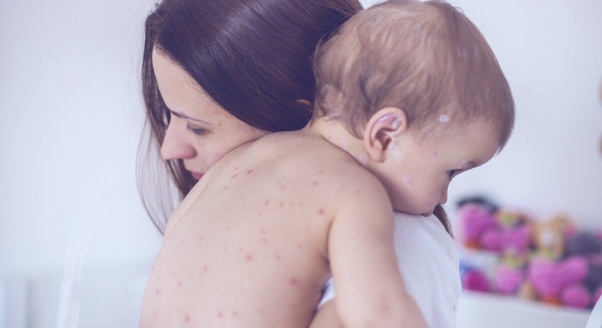 Eine besorgte Mutter hält ihr Baby liebevoll im Arm, das offensichtlich an Windpocken leidet, erkennbar an den vielen roten Pusteln auf seiner Haut. Das Kind liegt mit dem Gesicht nach unten auf der Schulter der Mutter, und beide befinden sich in einem hellen Raum. Die Szene drückt Sorge und mütterliche Fürsorge aus.