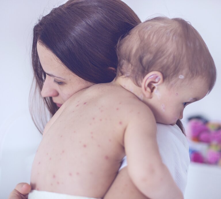 Eine besorgte Mutter hält ihr Baby liebevoll im Arm, das offensichtlich an Windpocken leidet, erkennbar an den vielen roten Pusteln auf seiner Haut. Das Kind liegt mit dem Gesicht nach unten auf der Schulter der Mutter, und beide befinden sich in einem hellen Raum. Die Szene drückt Sorge und mütterliche Fürsorge aus. | © iStock/south_Agency