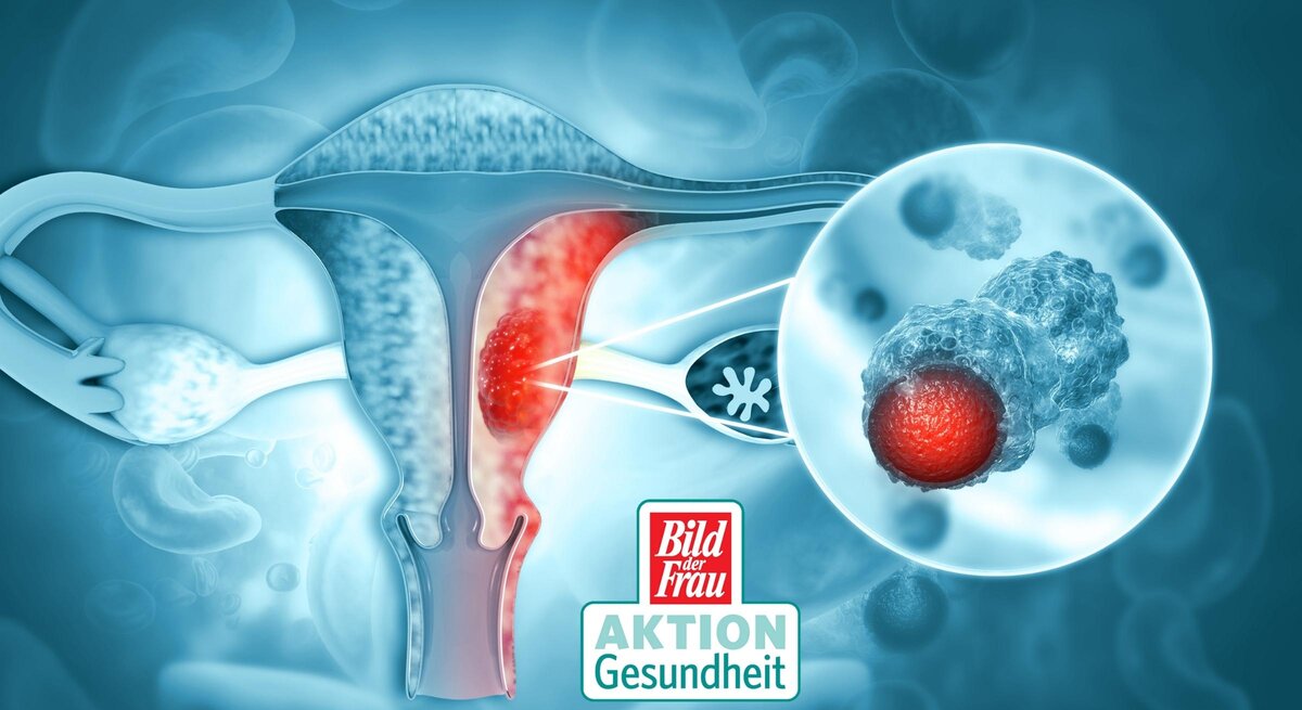 Illustration eines Querschnitts des weiblichen Reproduktionssystems mit Fokus auf den Gebärmutterhals, wo abnormale Zellveränderungen hervorgehoben sind, die Gebärmutterhalskrebs darstellen sollen. Ein vergrößertes Detail zeigt eine veränderte Zelle mit einem ungesunden Zellkern. Das Logo "Bild der Frau AKTION Gesundheit" ist eingefügt, was die Bedeutung der Aufklärung und Vorsorge in Bezug auf Gebärmutterhalskrebs betont. Die Visualisierung soll das Bewusstsein für Krebsvorsorge und Gesundheitschecks erhöhen.