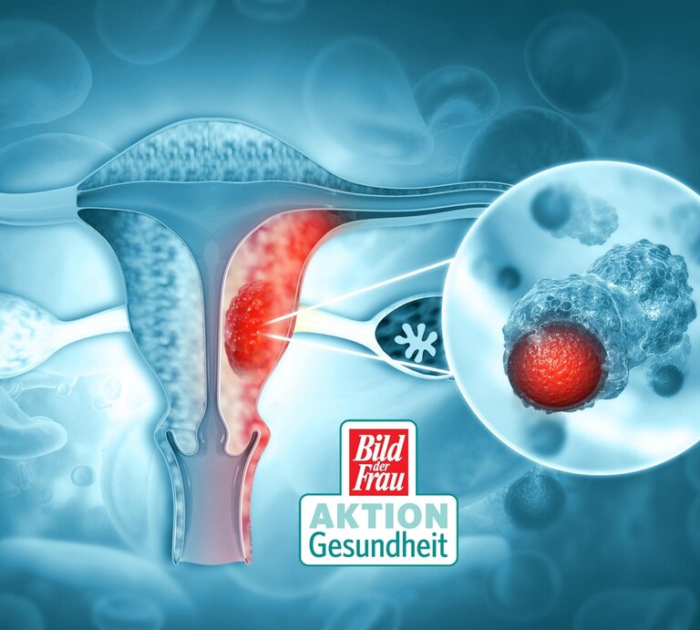 Illustration eines Querschnitts des weiblichen Reproduktionssystems mit Fokus auf den Gebärmutterhals, wo abnormale Zellveränderungen hervorgehoben sind, die Gebärmutterhalskrebs darstellen sollen. Ein vergrößertes Detail zeigt eine veränderte Zelle mit einem ungesunden Zellkern. Das Logo "Bild der Frau AKTION Gesundheit" ist eingefügt, was die Bedeutung der Aufklärung und Vorsorge in Bezug auf Gebärmutterhalskrebs betont. Die Visualisierung soll das Bewusstsein für Krebsvorsorge und Gesundheitschecks erhöhen. | © Getty Images/Mohammed Haneefa Nizamudeen [M]