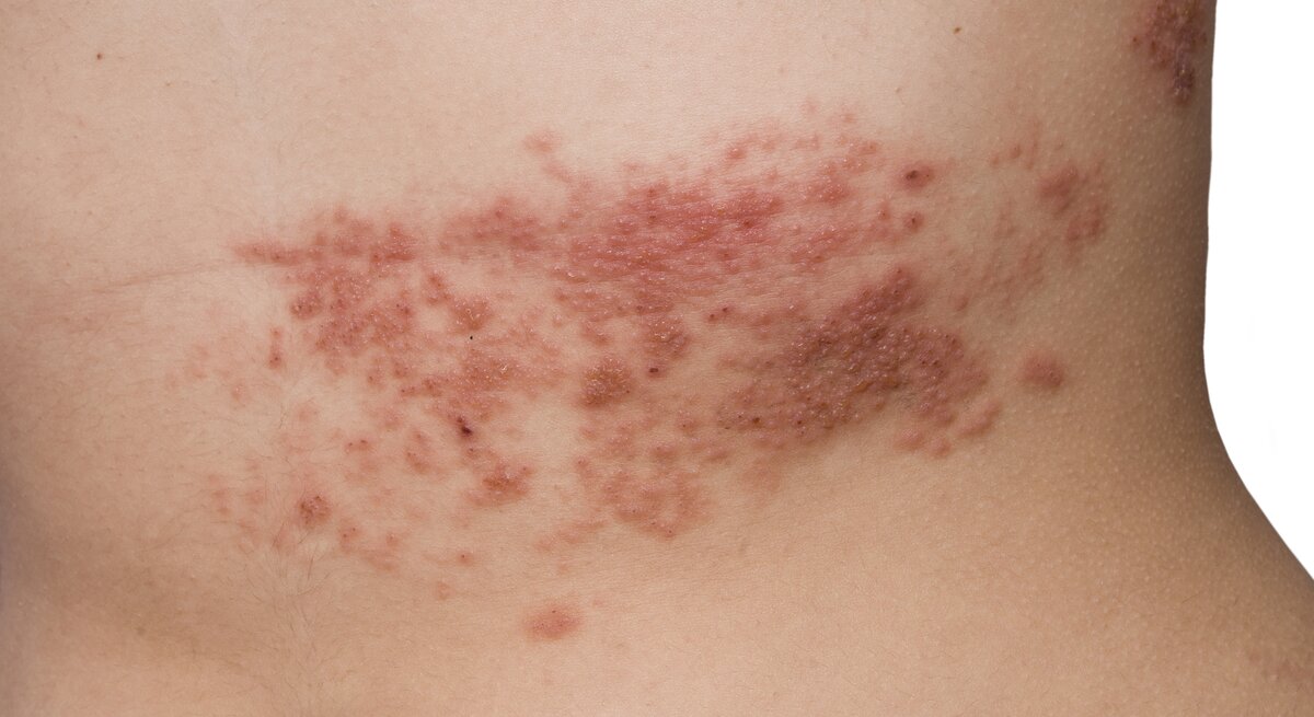 Herpes Zoster