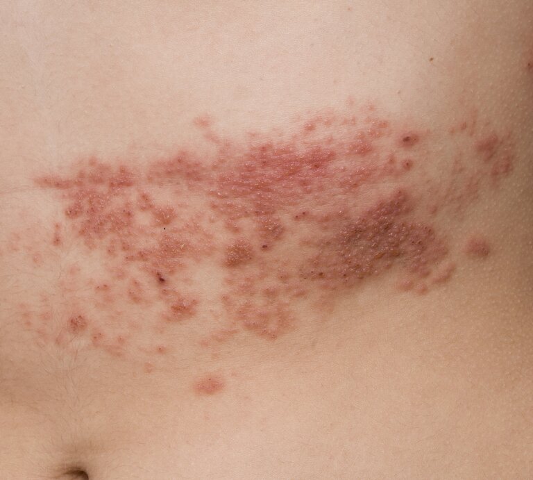 Herpes Zoster | © iStock/franciscodiazpagador