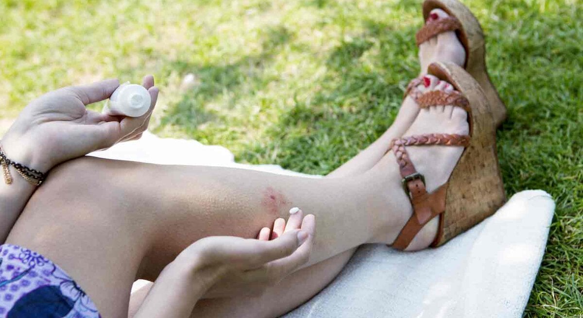 Beine einer Frau, die auf einer Wiese liegt und kühlendes Gel auf eine rote Stelle auf ihrer Haut aufträgt. Sie trägt sommerliche Sandalen mit hohen Absätzen und ein buntes Kleid.