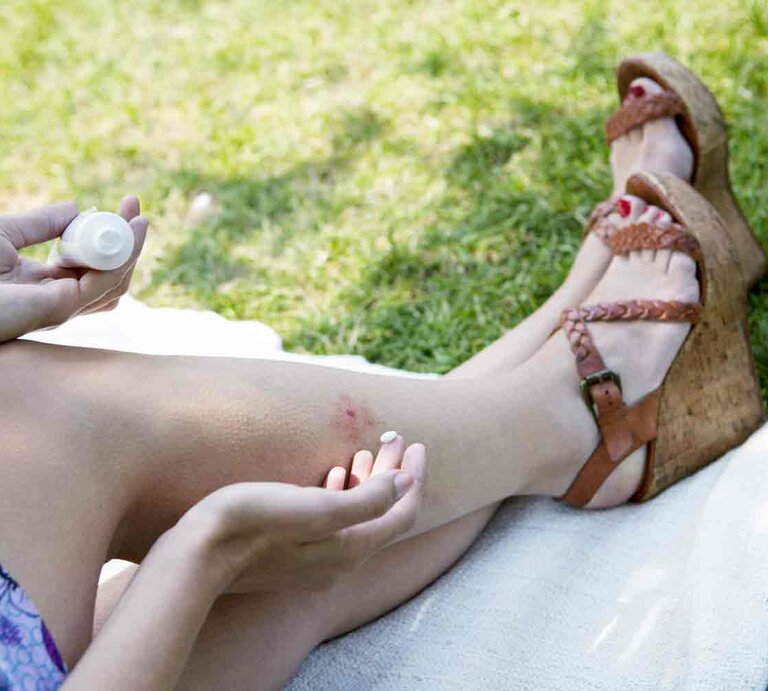 Beine einer Frau, die auf einer Wiese liegt und kühlendes Gel auf eine rote Stelle auf ihrer Haut aufträgt. Sie trägt sommerliche Sandalen mit hohen Absätzen und ein buntes Kleid. | © Shutterstock/Image Point Fr