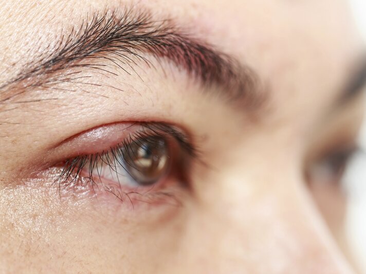 Ein Mensch hat ein leicht gerötetes Auge. | © iStock/PhanuwatNandee