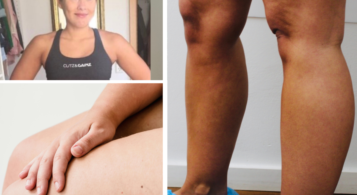 Collage aus drei Bildern: sportliche Frau in Trainingskleidung, Hand auf einem Oberschenkel, Beine mit blauen Einwegüberziehern.