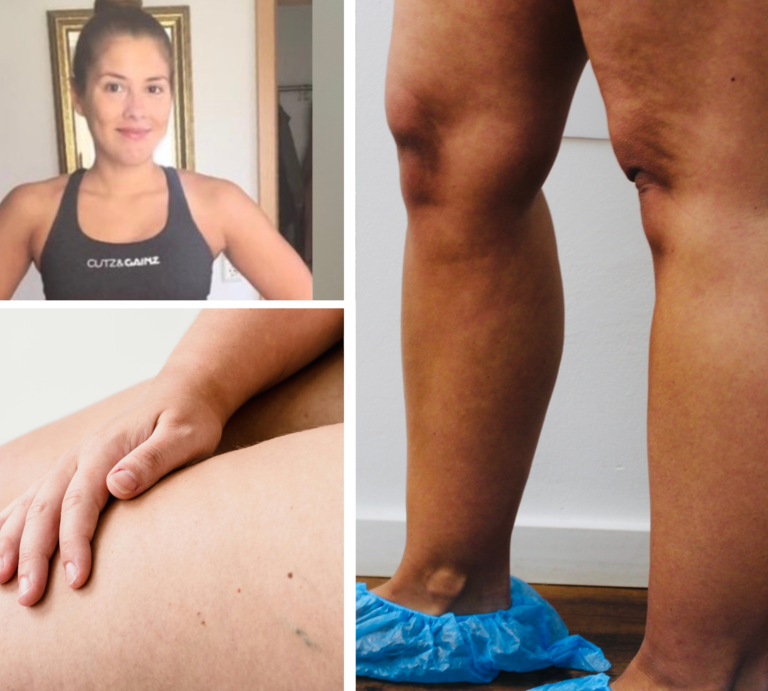 Collage aus drei Bildern: sportliche Frau in Trainingskleidung, Hand auf einem Oberschenkel, Beine mit blauen Einwegüberziehern. | © Canva / privat [M]