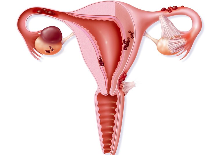 Endometriose Vagina | © Your Photo Today