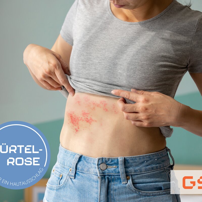 Frau, die ein Hautproblem im Bereich ihrer Taille enthüllt, indem sie ihr graues T-Shirt anhebt. Auf ihrer Haut sind deutliche Anzeichen einer Gürtelrose zu erkennen, erkennbar an den roten, entzündeten Bläschen. | © Adobe Stock / ryanking999