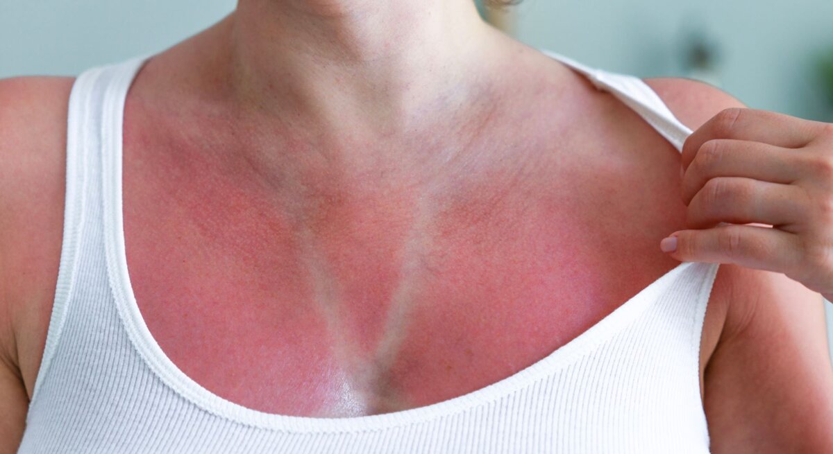 Eine Frau mittleren Alters zeigt in weißem Top ihre gerötete Haut mit deutlichem Sonnenbrand und heller Streifenbräune.