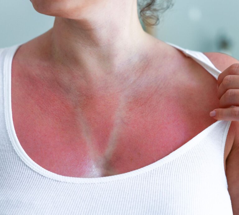 Eine Frau mittleren Alters zeigt in weißem Top ihre gerötete Haut mit deutlichem Sonnenbrand und heller Streifenbräune. | © Adobe Stock/ dragonstock